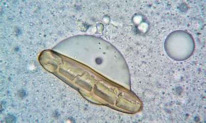 Un gen controla si las células del cáncer de mama se diseminan o permanecen dormidas