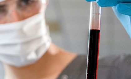 Hiperdiploidia prenatal podría ser el primer paso de la leucemia infantil, según un estudio