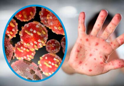 Imagen de  Reciente informe de viruela símica registra seis casos en el Oriente Antioqueño