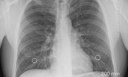 La fibrosis pulmonar, silenciosa y mortal