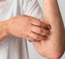 Confirman cuatro casos de sarampión en Colombia y refuerzan alertas sanitarias