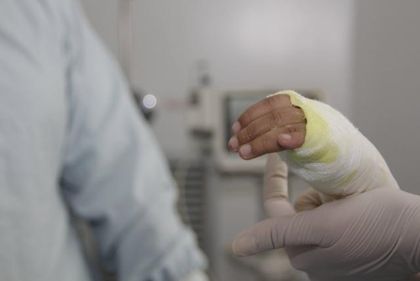 Imagen de Nuevos casos de quemados por pólvora en Antioquia: niño de tres años entre los afectados