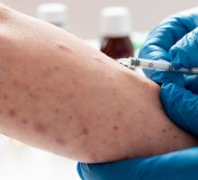 Ministerio de Salud confirma casos de sarampión en Colombia e intensifica la vacunación y la vigilancia epidemiológica