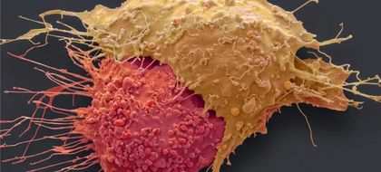 Imagen de  OvarianVax: así funciona la primera vacuna contra el cáncer de ovario