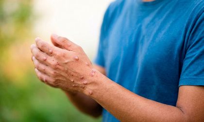 Minsalud confirmó primer caso de viruela del mono