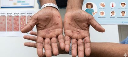 Imagen de Detectan en Antioquia primer caso de viruela símica. ¿Cuáles son las recomendaciones?