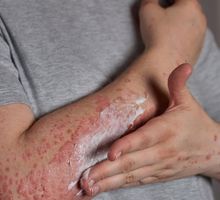 Confirman quinto caso de sarampión importado en Colombia y refuerzan controles sanitarios