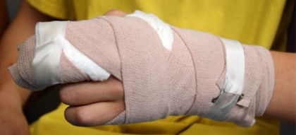 Imagen de Apenas inicia diciembre y ya son 20 los quemados por pólvora en Antioquia