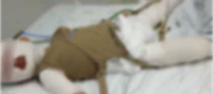 Imagen de  ¡Ayudemos a Alan Stiven! Niño de El Carmen sufrió graves quemaduras y está hospitalizado en Medellín