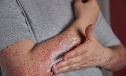 Confirman quinto caso de sarampión importado en Colombia y refuerzan controles sanitarios