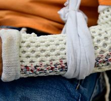 ¿Por qué casi la mitad de los niños sufrirá una fractura antes de la adolescencia?