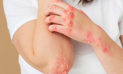 Una enfermedad crónica aumenta el riesgo de herpes zóster