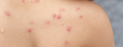 Imagen de ¿Qué se sabe del caso de viruela del mono detectado en Antioquia?