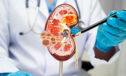 Siete reglas de oro para prevenir la enfermedad renal crónica