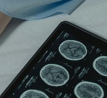 Alivian el Tourette más grave con estimulación cerebral profunda