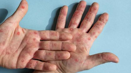 Imagen de  Aumenta el número de casos de viruela símica en Rionegro