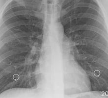 La fibrosis pulmonar, silenciosa y mortal
