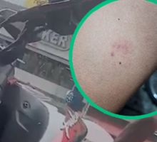 Agresión a agente de tránsito en Cali: recibió una mordedura durante un procedimiento de inmovilización