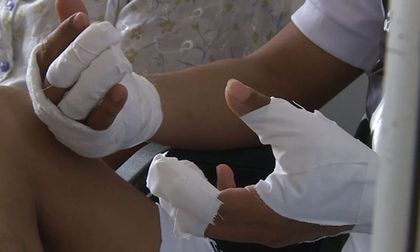 Las autoridades mantienen vigilancia intensificada por personas quemadas con pólvora en el Valle