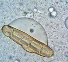 Un gen controla si las células del cáncer de mama se diseminan o permanecen dormidas