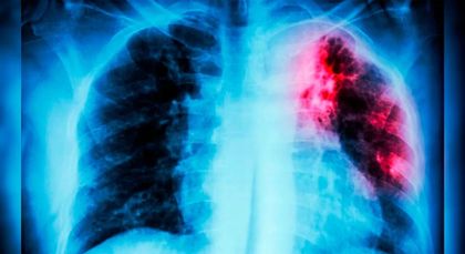 Imagen de  Antioquia, el primer departamento en implementar pruebas vanguardistas para el diagnóstico rápido de tuberculosis