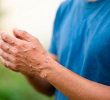 Minsalud confirmó primer caso de viruela del mono