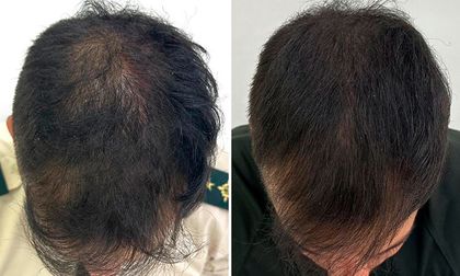 La solución definitiva contra la caída del cabello: Conoce Hair2You