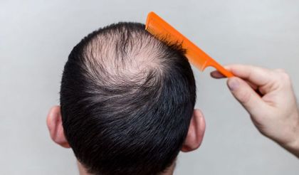 alopecia-caida-cabello- tratamientos-Svenson