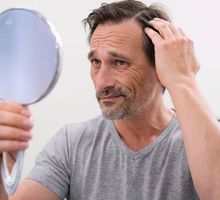 Fraudes con remedios milagrosos contra la calvicie, abundan en las redes