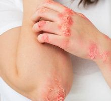 Una enfermedad crónica aumenta el riesgo de herpes zóster