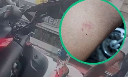 Agresión a agente de tránsito en Cali: recibió una mordedura durante un procedimiento de inmovilización