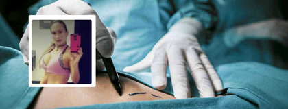 Imagen de  Desalmado: cirujano le inyectó aceite para carros en los glúteos a una mujer en Medellín