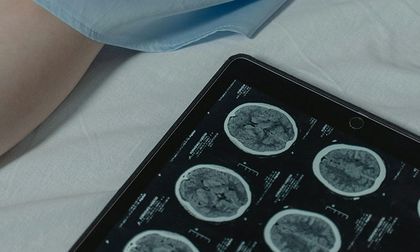 Alivian el Tourette más grave con estimulación cerebral profunda