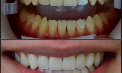 Tratamientos odontológicos que son tendencia en este cierre de año