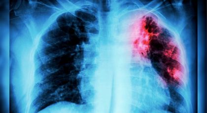 Imagen de  El Oriente es la segunda subregión de Antioquia con más casos de tuberculosis