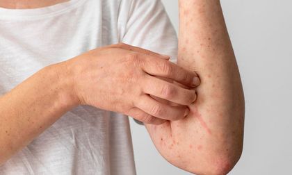 Confirman cuatro casos de sarampión en Colombia y refuerzan alertas sanitarias