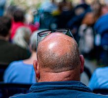 Bebidas azucaradas y energizantes podría aumentar calvicie masculina